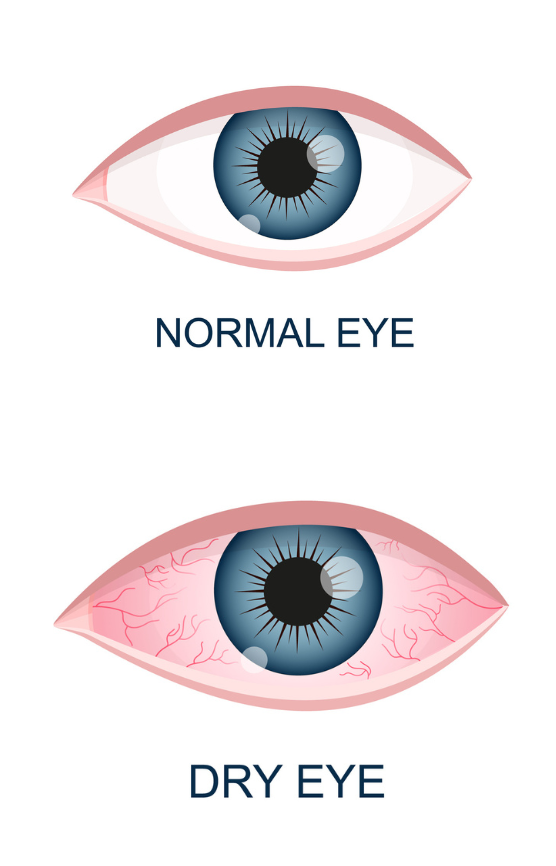 comparison between a normal eye and a dry eye